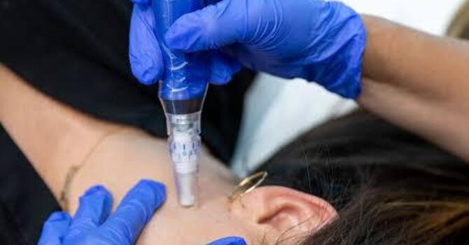 Microneedling
